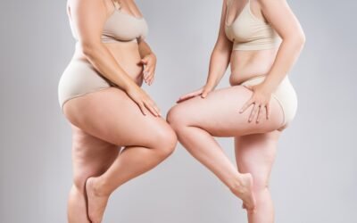 lipodem ile kilo sebebimi Veremediğiniz İnatçı Kiloların Sebebi Lipödem Olabilir