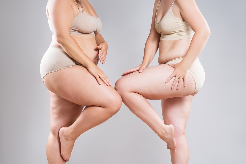 lipodem ile kilo sebebimi Veremediğiniz İnatçı Kiloların Sebebi Lipödem Olabilir